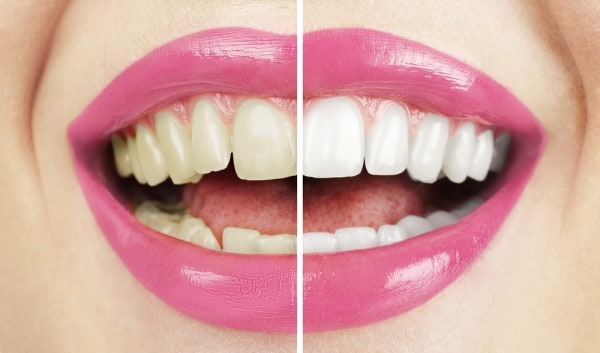 What Makes Ultima White Teeth Whitening Different Cambridge