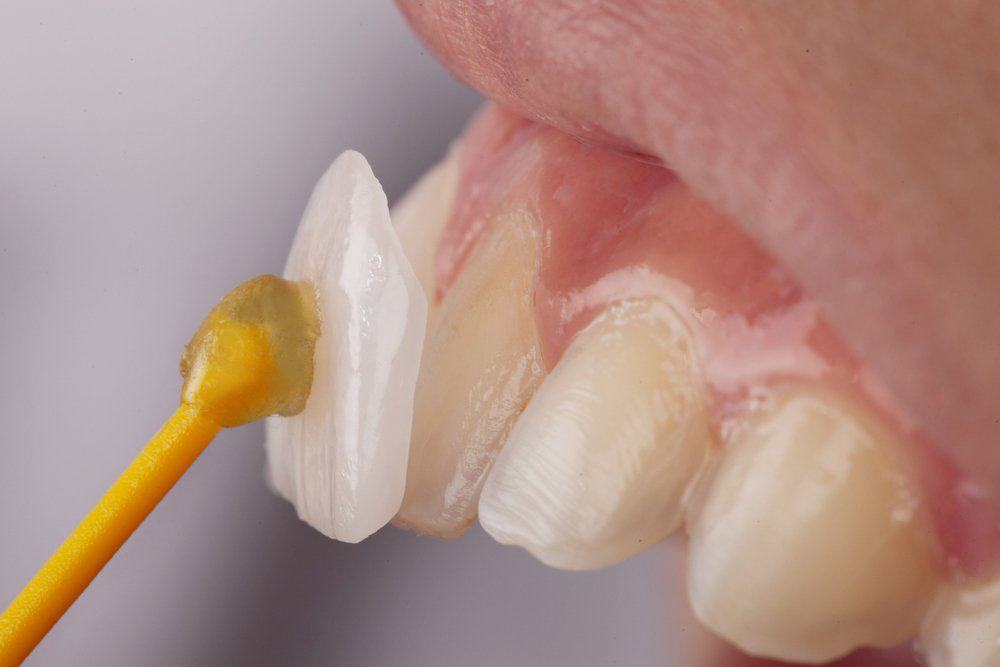 Dental Veneers: Achieving a Flawless Look Cambridge