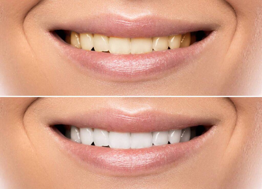 How Can You Protect Your White Smile as a Coffee Lover Cambridge?