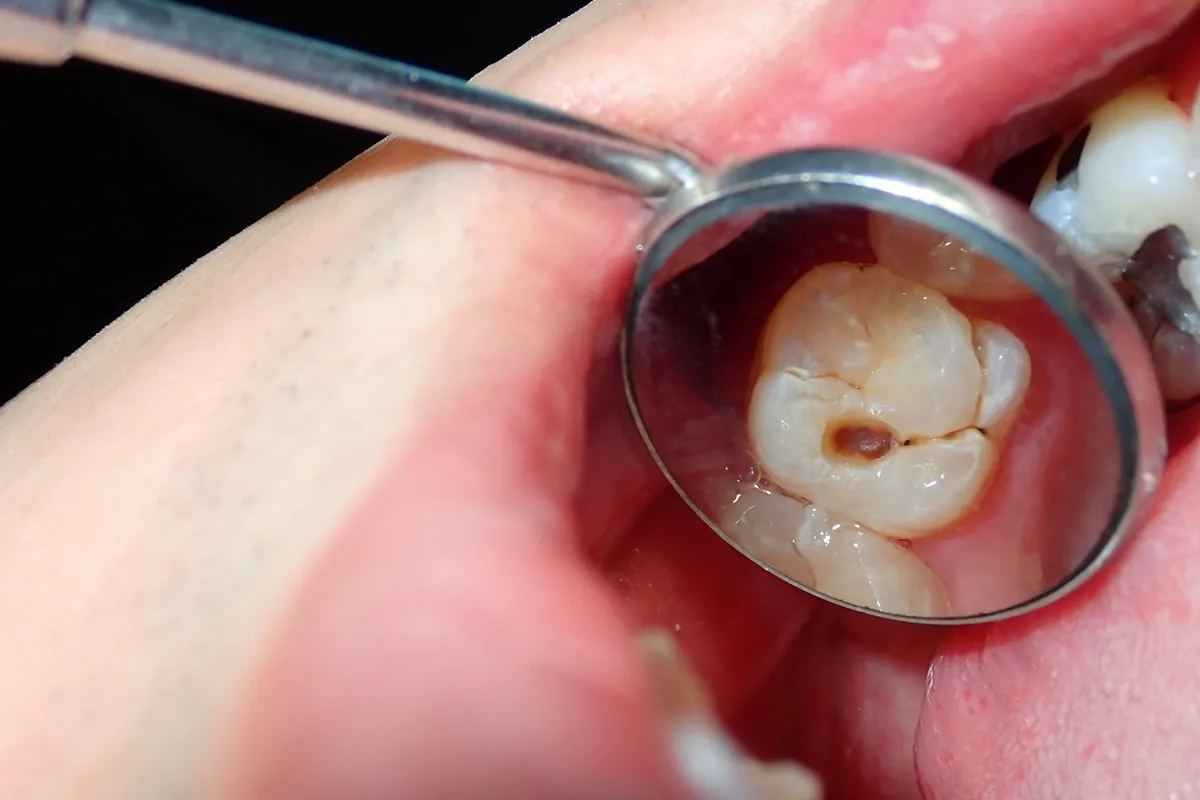 Why Do Teeth Crack? Common Causes to Know Cambridge