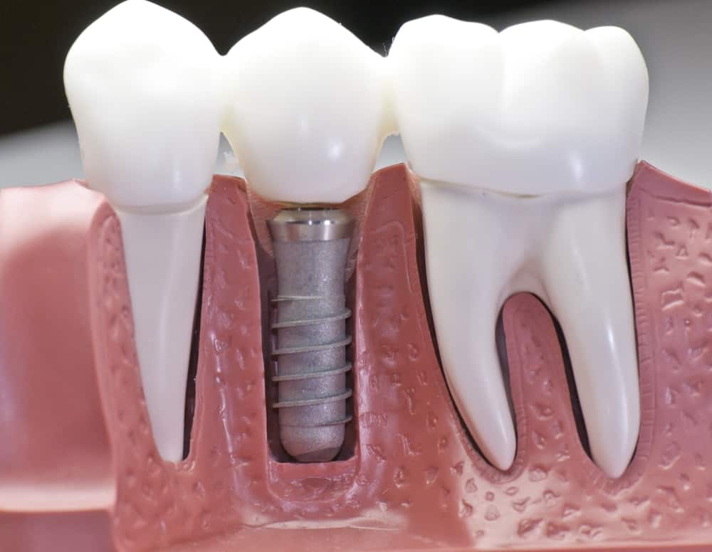 Common Misconceptions About Modern Dental Treatments Cambridge