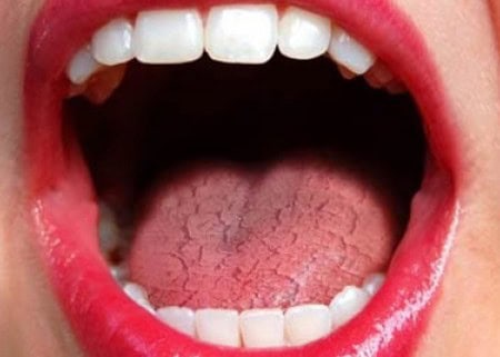 Dry Mouth and Its Role in Tooth Decay Cambridge