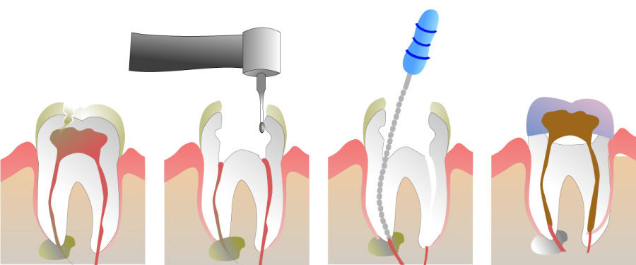 How Do You Properly Care for Your Teeth After a Root Canal Cambridge