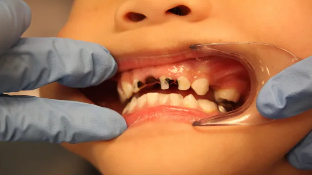 Tips for Keeping Your Child’s Baby Teeth Healthy and Strong Cambridge