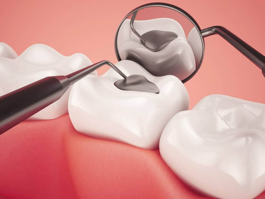 Fighting Cavities and Plaque Buildup Cambridge