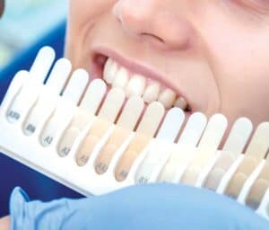 Ultimate Guide to Teeth Whitening with Natural Ingredients Cambridge