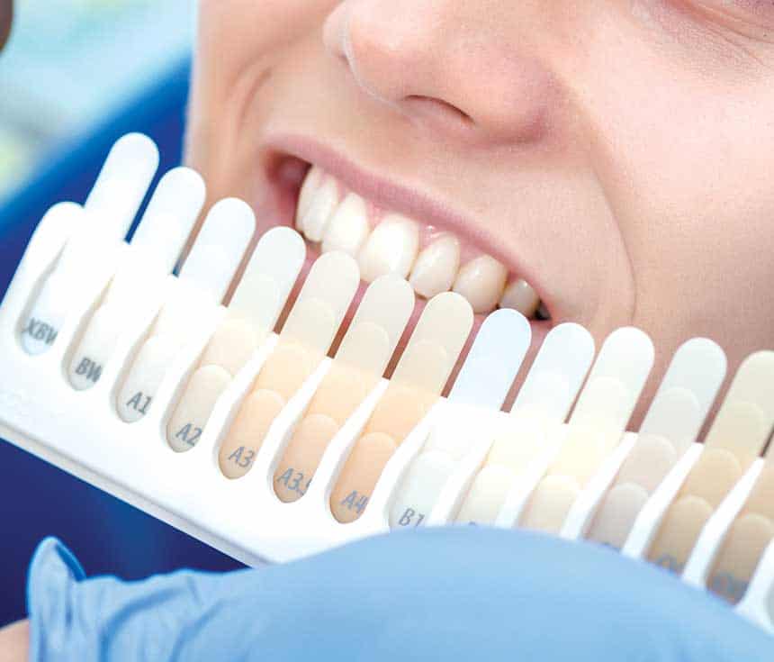 What Happens During Laser Teeth Whitening and How Long the Results Usually Last Cambridge