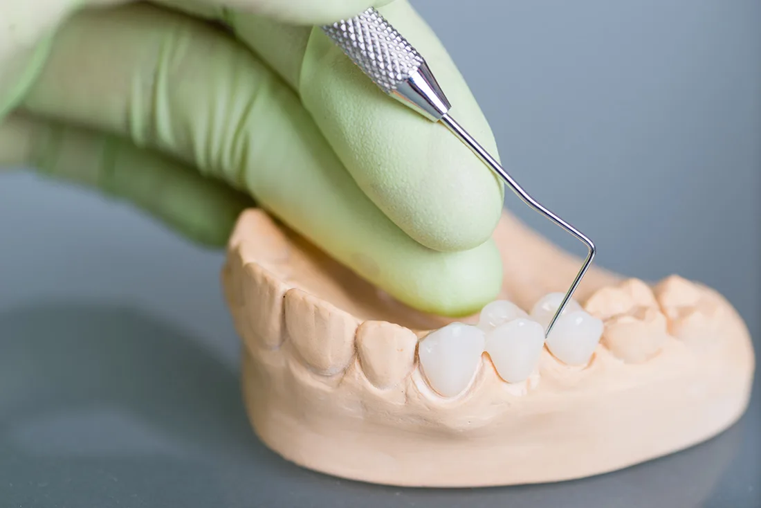 Do Braces Take Years to Show Results Cambridge