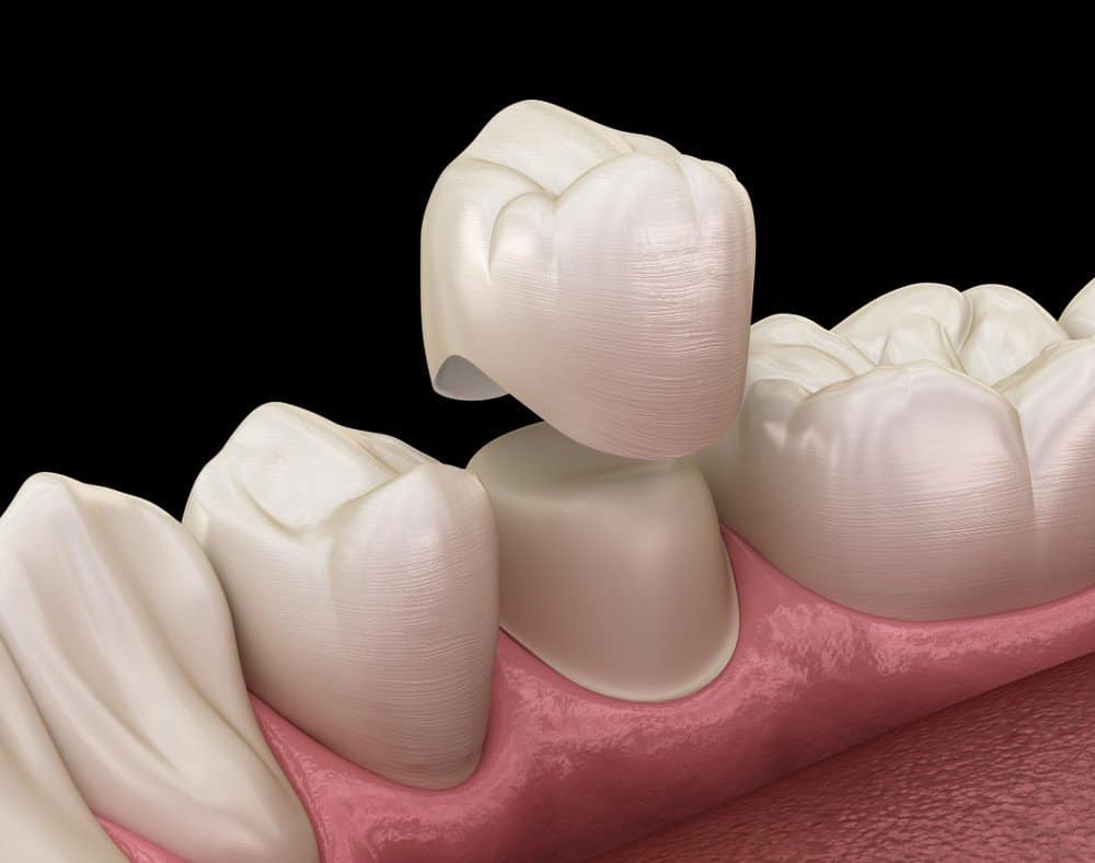 Teeth Whitening: Separating Facts from Fiction Cambridge