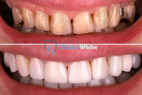 What Makes Instant Teeth Whitening Treatments So Popular Cambridge?