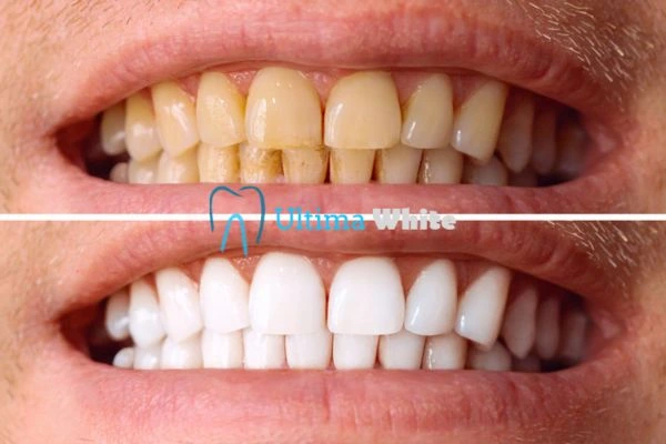 Stained Teeth and Persistent Bad Breath Cambridge