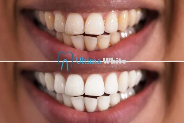 Aftercare Tips to Maintain Your New Smile Cambridge